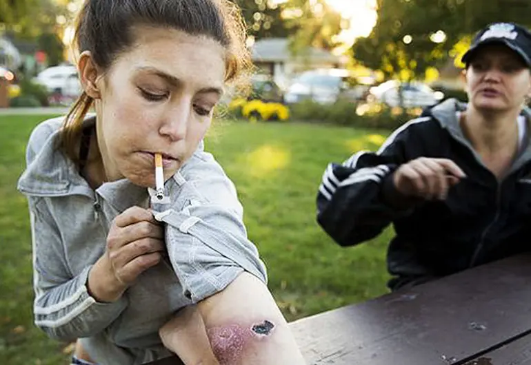 FOTOGALERÍA: ¿Qué se siente, por qué los jóvenes consumen Krokodil?